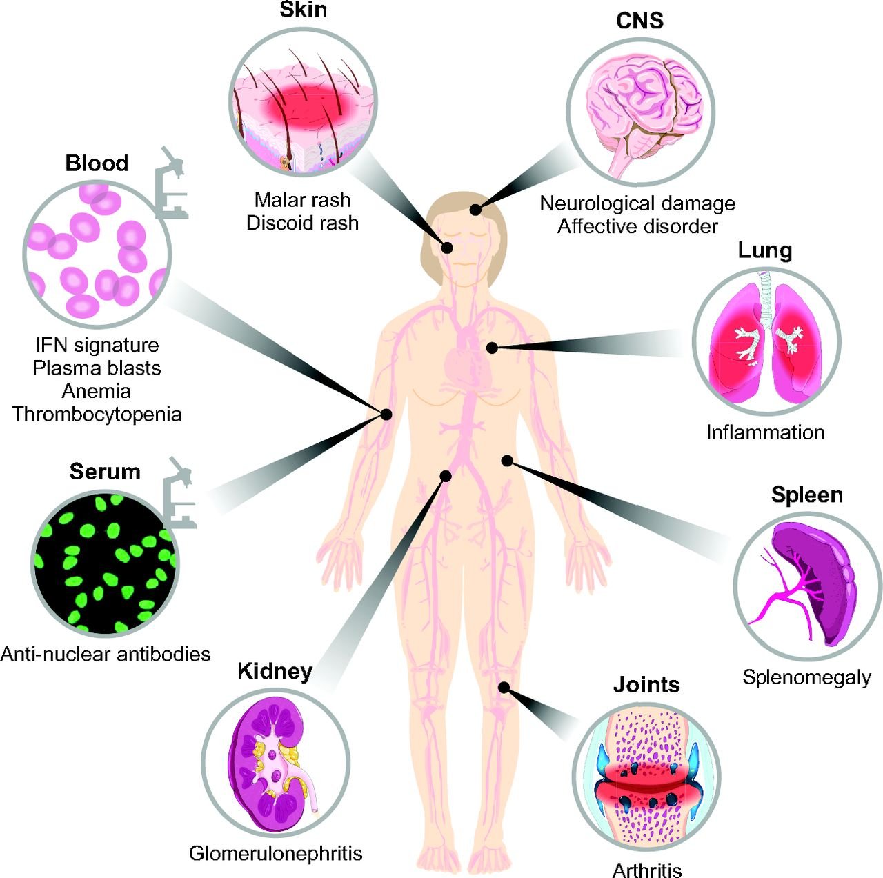 systemic lupus erythematosus /SLE