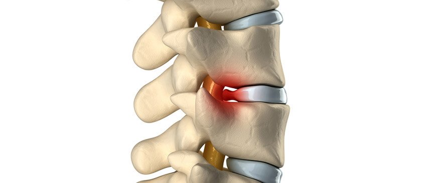 Lumbosacral Disc Herniation