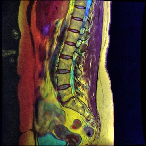 Retrolisthesis