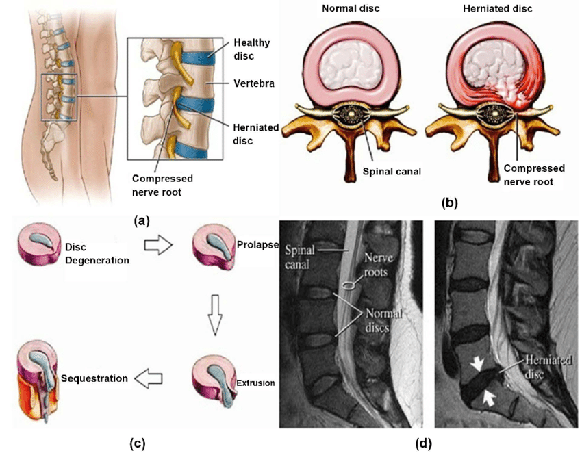 Intervertebral Disc Herniation