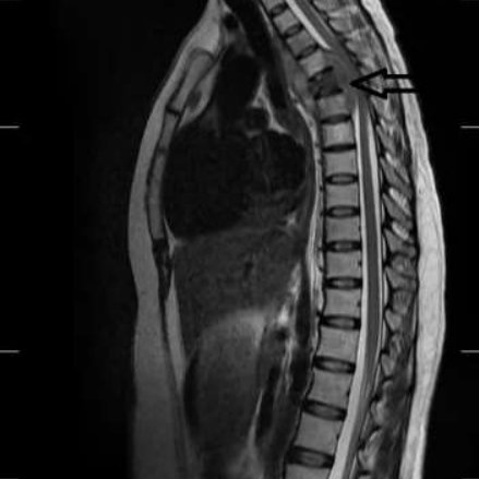 Prolapsed Intervertebral Disc