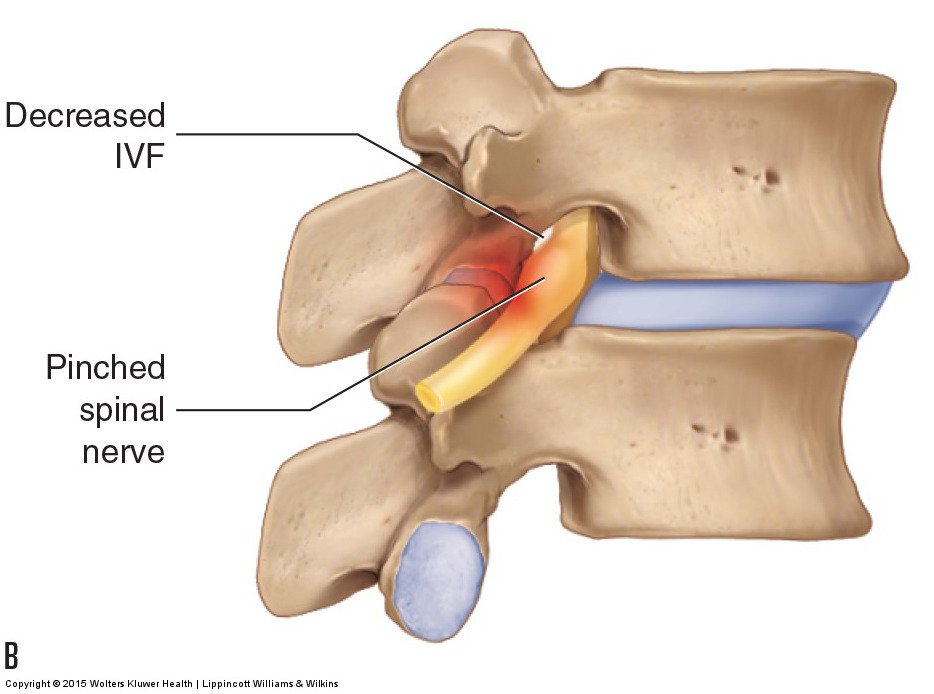 Prolapsed Intervertebral Disc