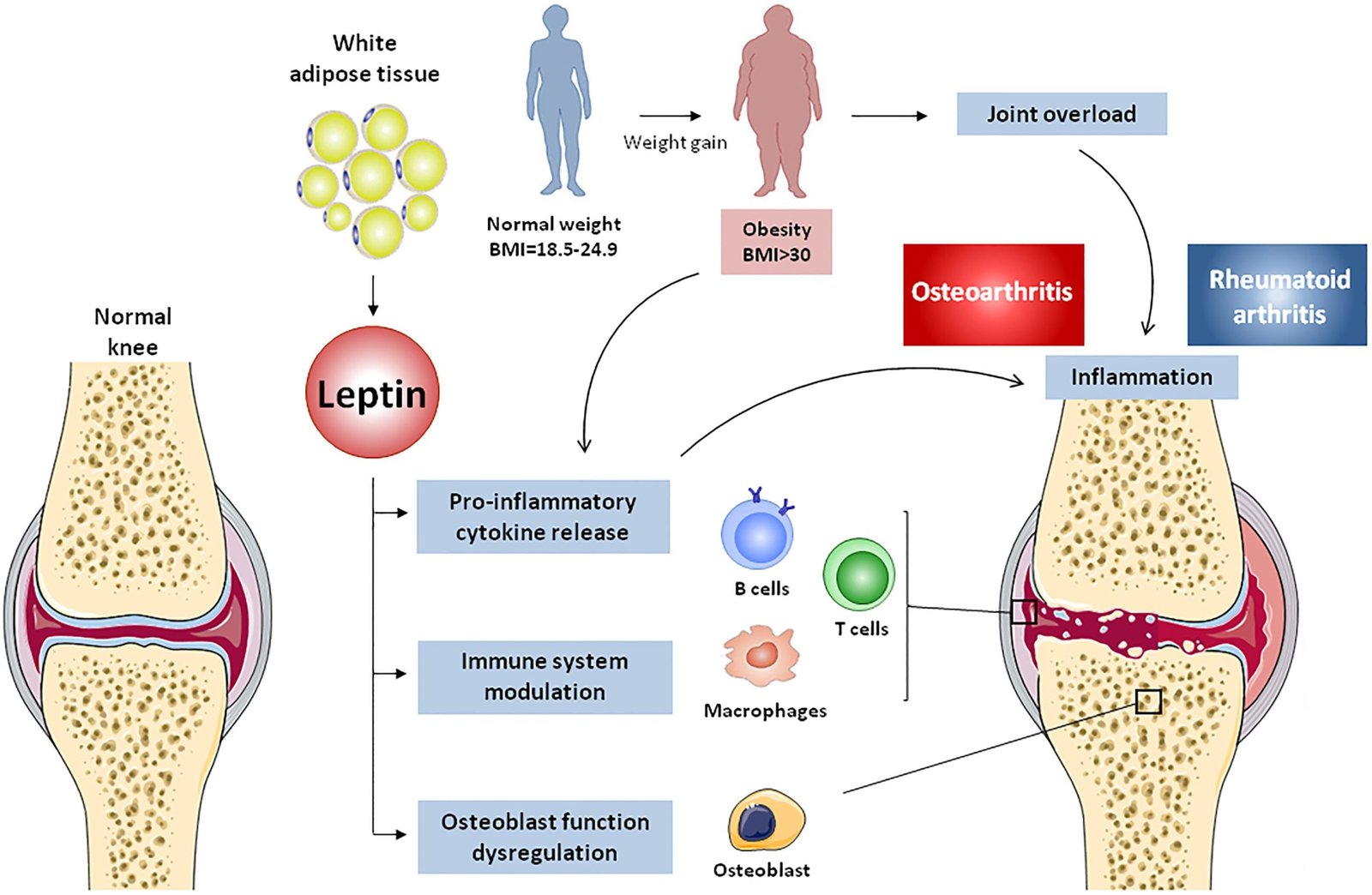 Early Symptoms of Knee Osteoarthritis