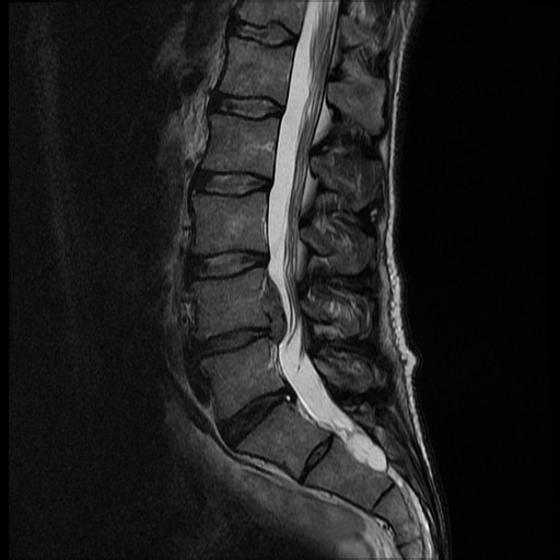 Tuberculous Spondylitis