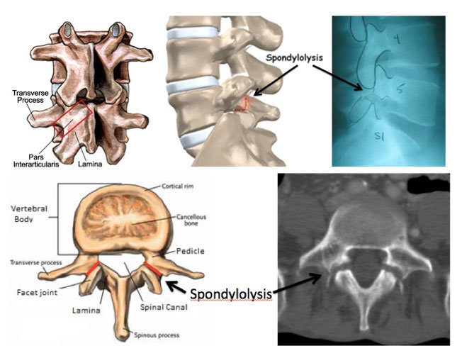 Pars Interarticularis Defect