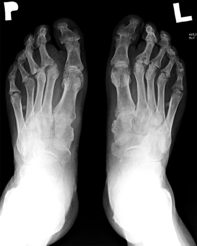 Chronic Inflammatory Arthritis