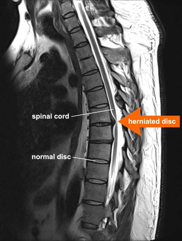 Intervertebral Disc Herniation