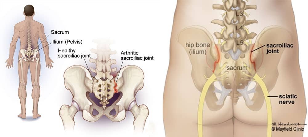 Sacroiliac Joint Trauma 