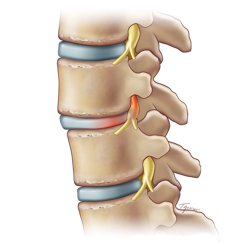 Spinal Tuberculosis