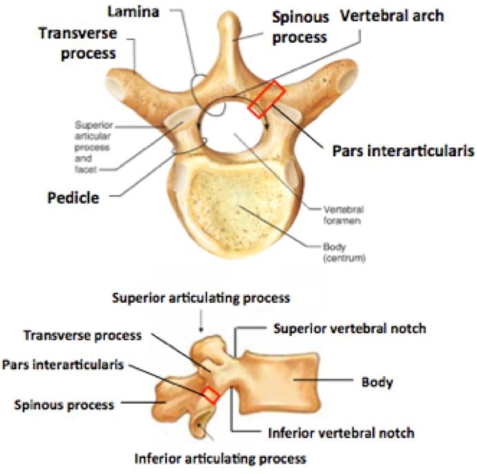 Lumbar Spondylolysis and Spondylolisthesis