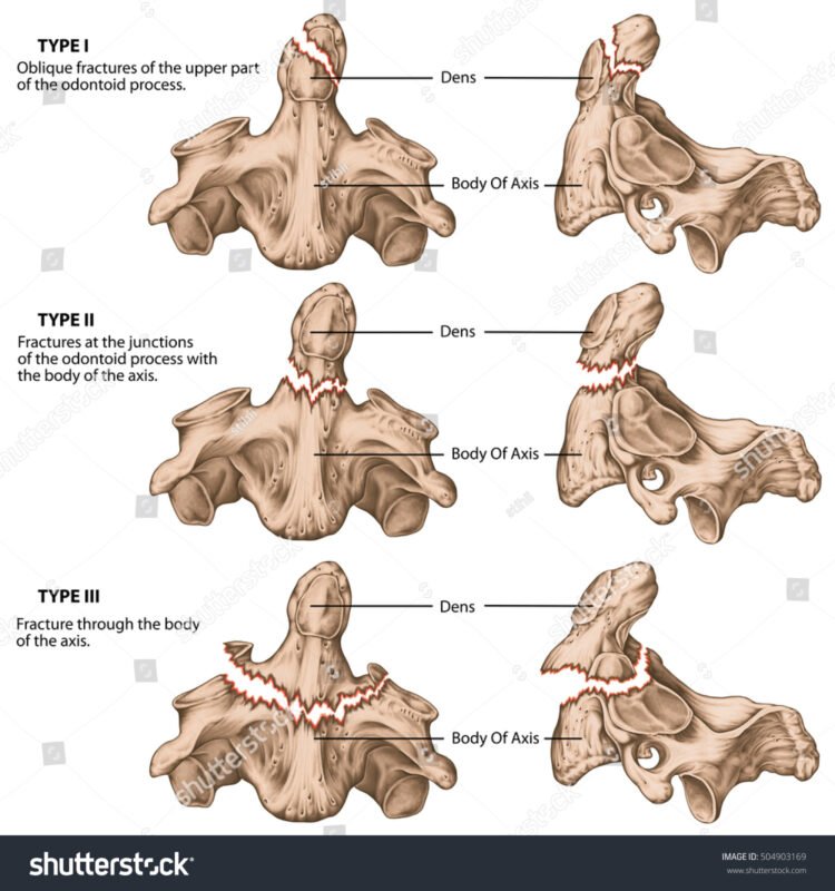 C2 C3 Vertebrae Fracture