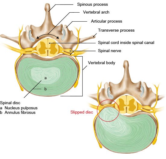 Lumbosacral Radiculopathy - Causes, Symptoms, Treatment - Rxharun