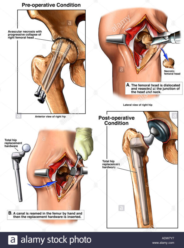 Anterior Dislocation