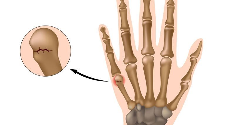 Metacarpal fractures