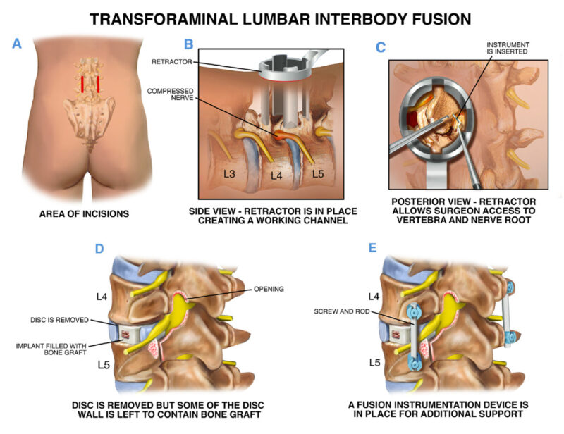 Chronic Low Back Pain – Causes, Symptoms, Treatment