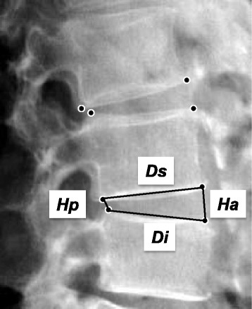 Loss of Disc Height Between L4 - L5 Vertebra Loss of Disc Height Between L4 - L5 Vertebra