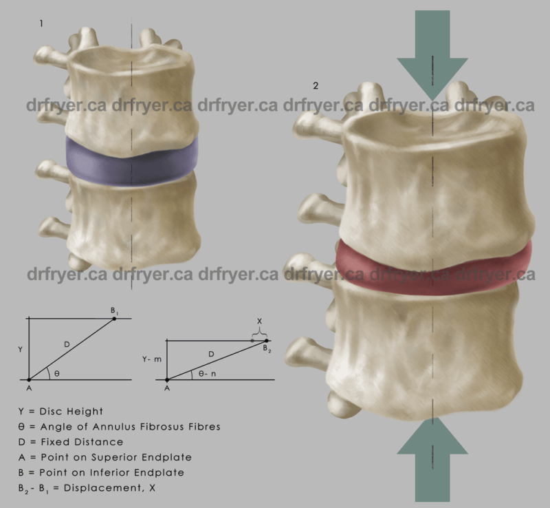 Symptoms Of Loss of Disc Height Between L3 – L4 Vertebra