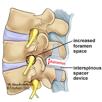 Bilateral Foraminal Stenosis Between L2 - L3 Vertebra Bilateral Foraminal Stenosis Between L2 - L3 Vertebra