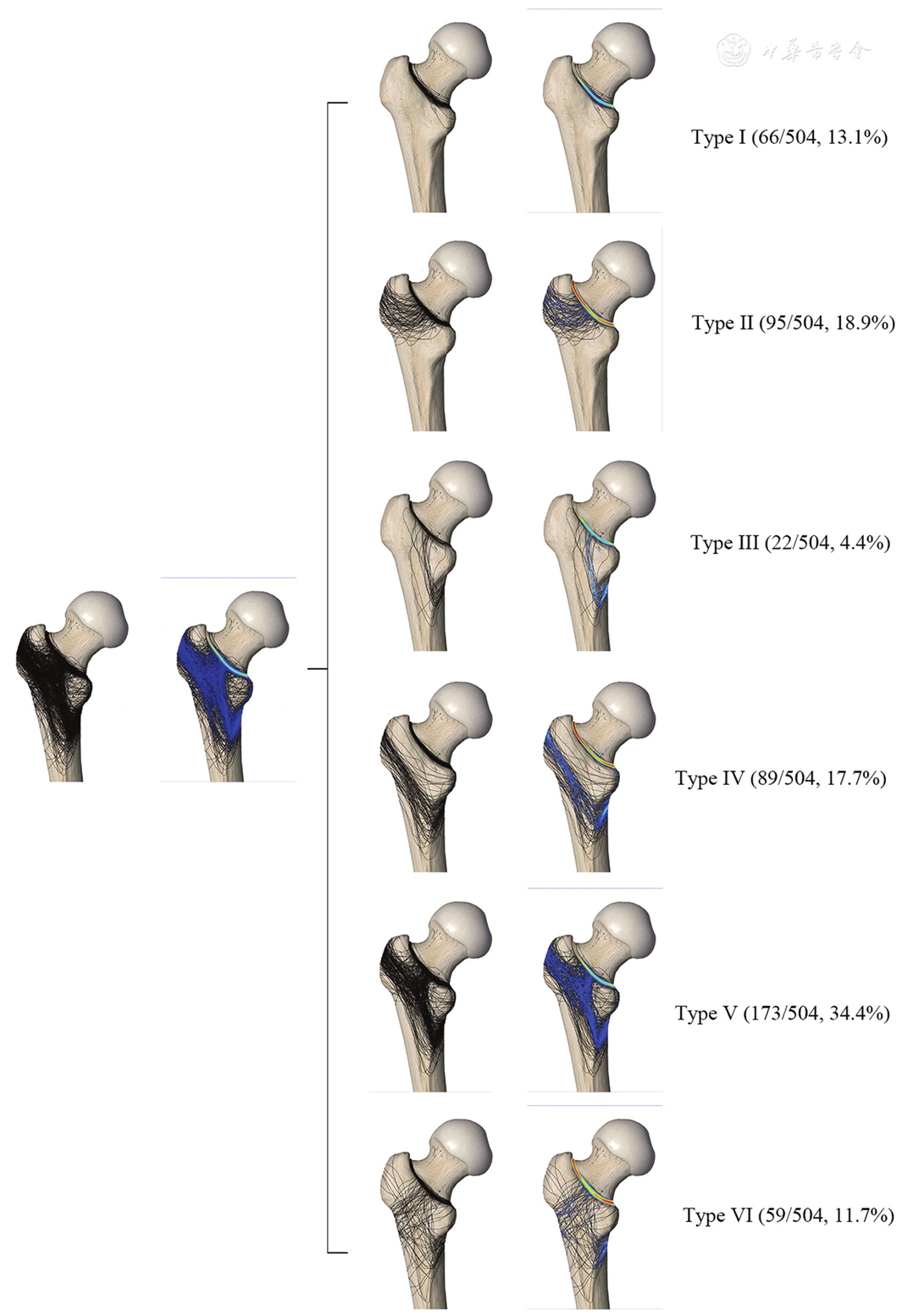 Intertrochanteric Femur Fracture