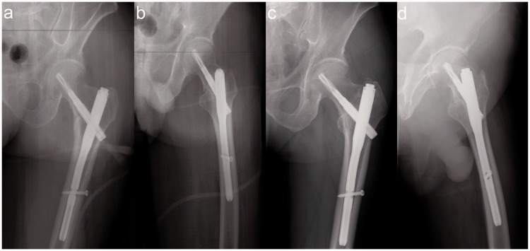 Basicervical Femoral Neck Fracture Basicervical Femoral Neck Fracture