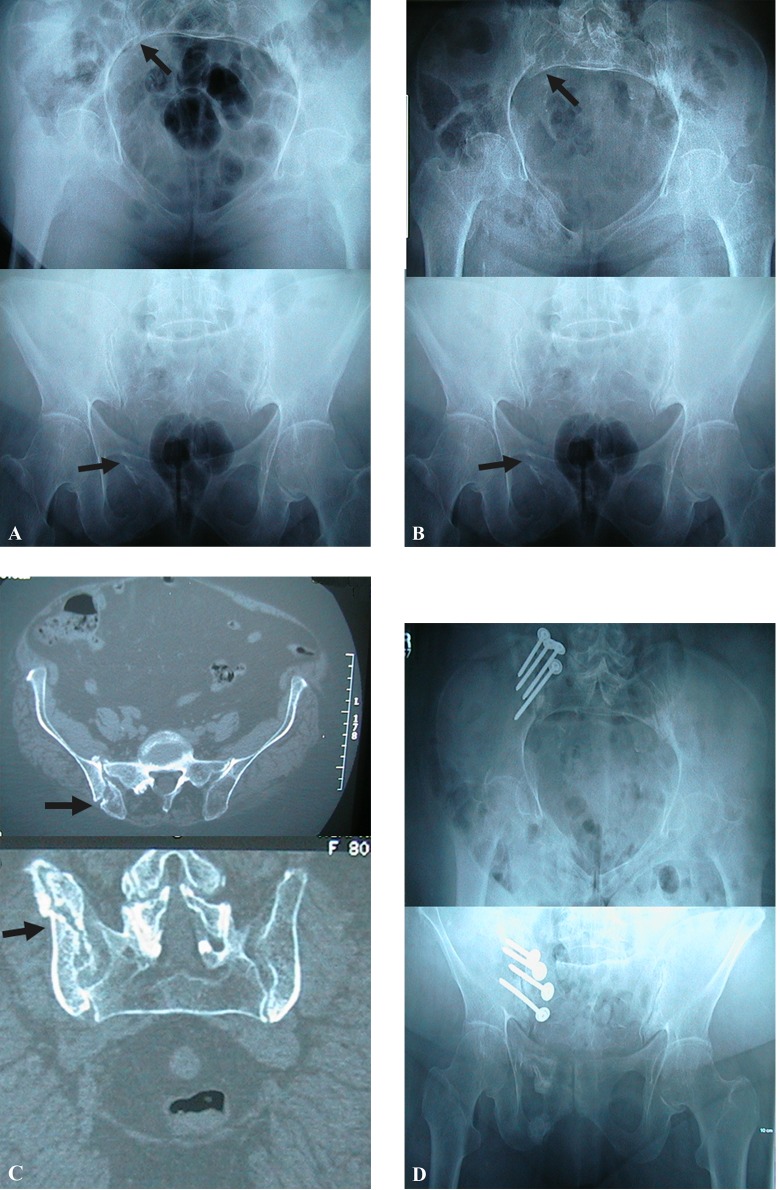 Pelvic Insufficiency Fractures Pelvic Insufficiency Fractures