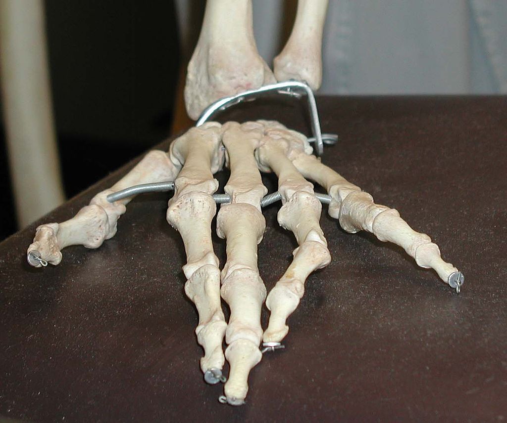 Phalangeal Neck Fractures