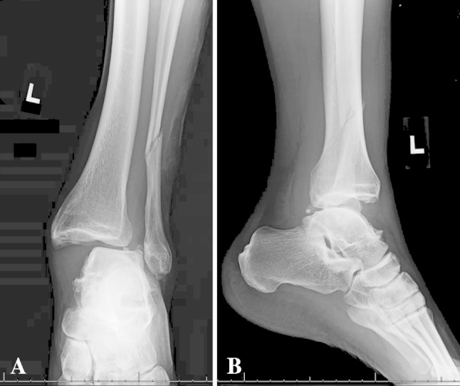 Lauge-Hansen Classification