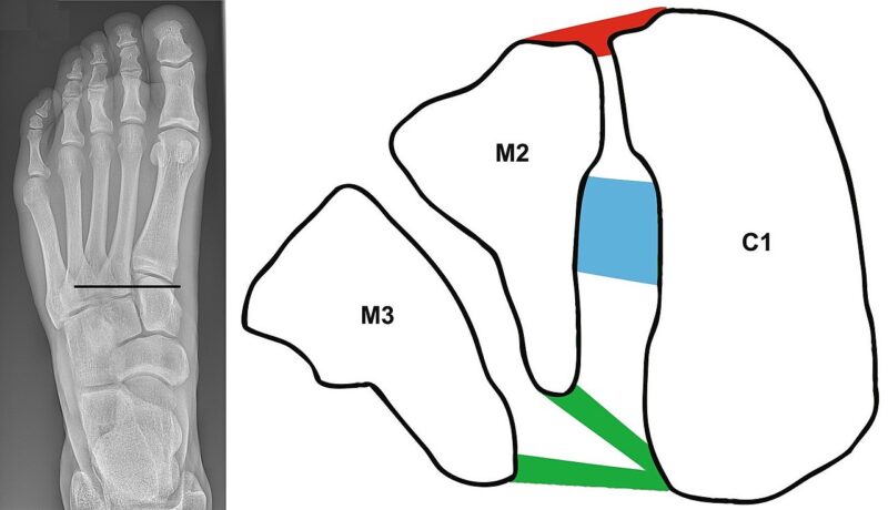 Lisfranc injuries - Causes, Symptoms, Diagnosis, Treatment