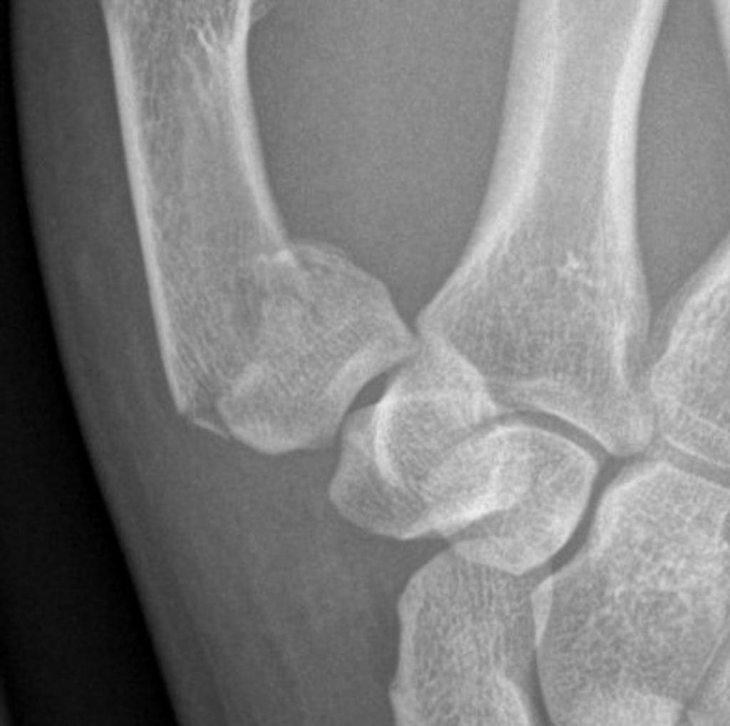 Epibasal Fractures of The Thumb