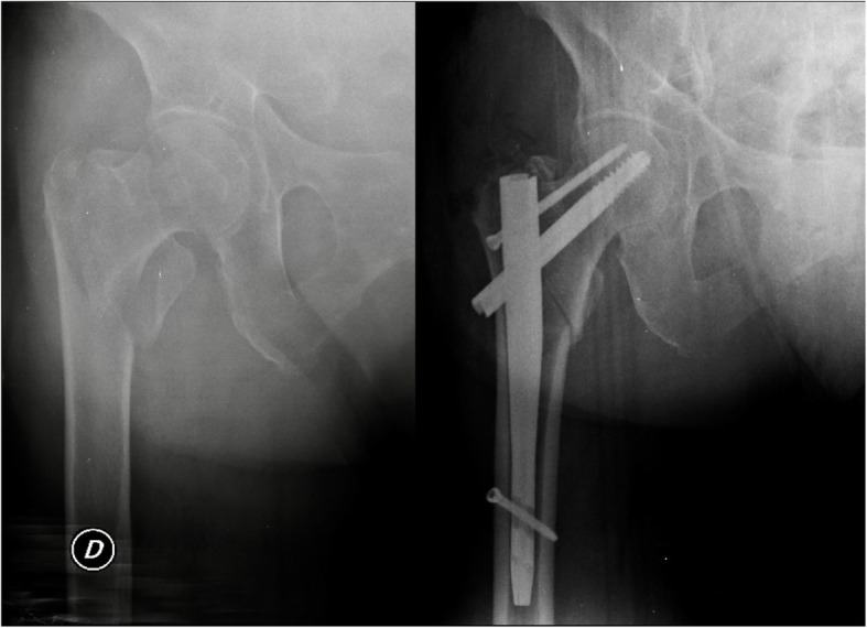 Pertrochanteric Femoral Fractures Pertrochanteric Femoral Fractures