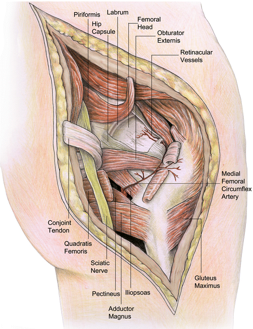 Femoral Head Fracture Femoral Head Fracture