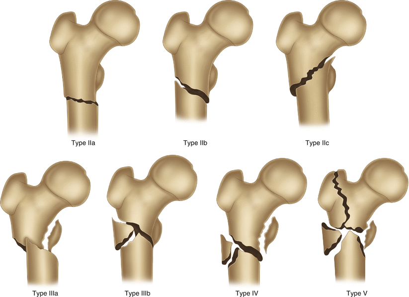 Subtrochanteric Fractures Subtrochanteric Fractures