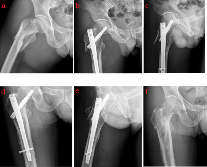 Intertrochanteric Femur Fracture