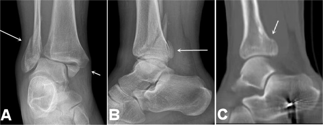 Weber's Ankle Fracture Classification (or Danis-Weber classification)