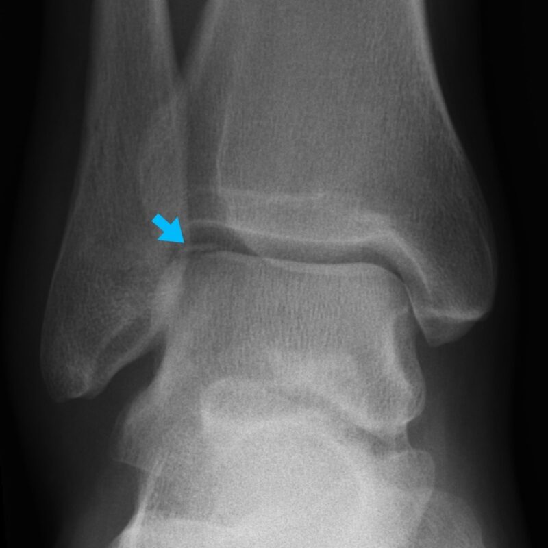 Talar Dome Osteochondral Fracture Talar Dome Osteochondral Fracture