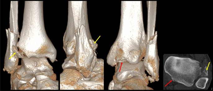 Maisonneuve Fracture Maisonneuve Fracture