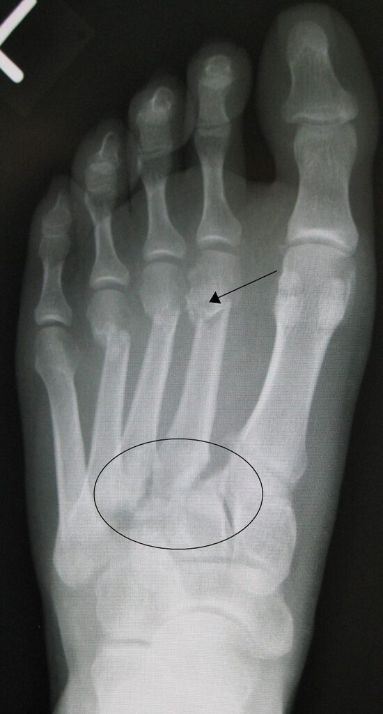 Lisfranc injuries - Causes, Symptoms, Diagnosis, Treatment