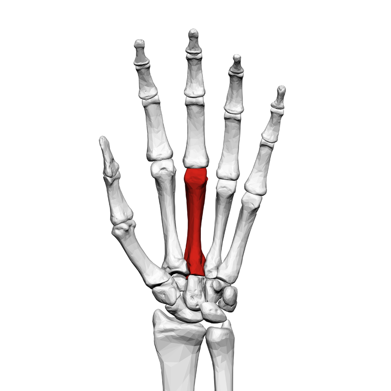 Third Metacarpal Head Fracture Third Metacarpal Head Fracture
