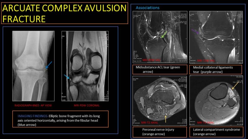 Arcuate Complex Avulsion Fracture (arcuate sign) Arcuate Complex Avulsion Fracture (arcuate sign)