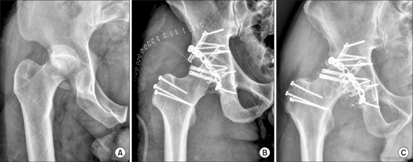 Femoral Head Fracture Femoral Head Fracture