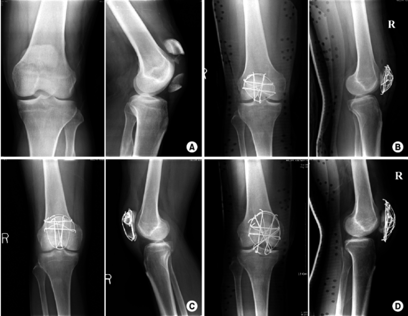 Patella Fracture - Causes, Symptoms, Diagnosis, Treatment Patella Fracture - Causes, Symptoms, Diagnosis, Treatment