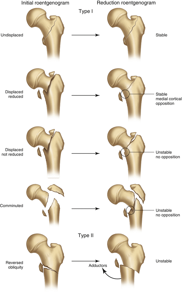 Pertrochanteric Femoral Fractures Pertrochanteric Femoral Fractures