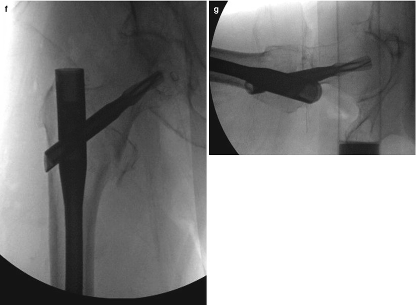 Pertrochanteric Femoral Fractures Pertrochanteric Femoral Fractures
