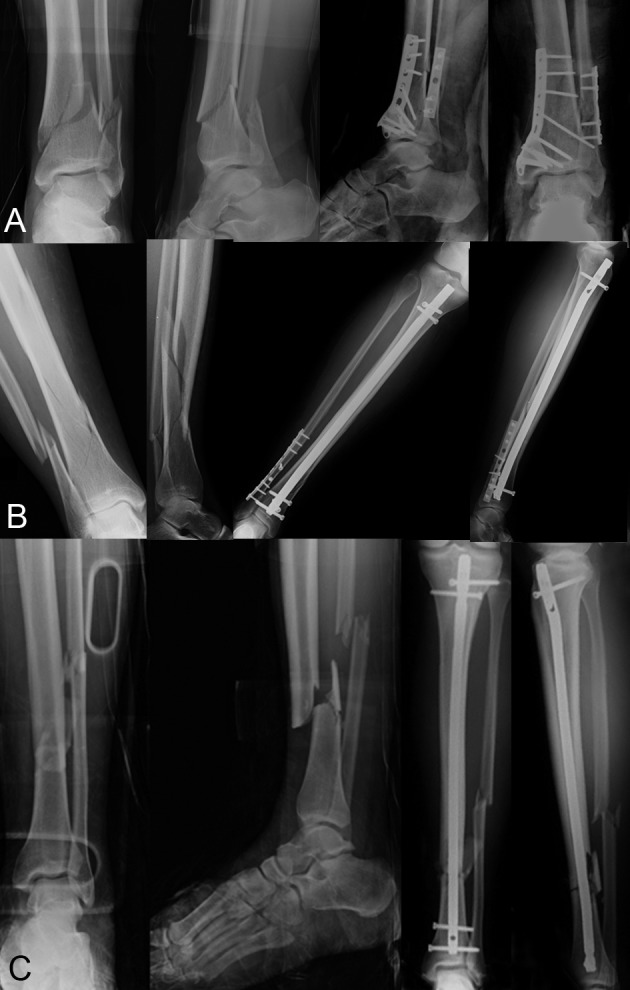 Fibula Fracture - Causes, Symptoms, Diagnosis, Treatment
