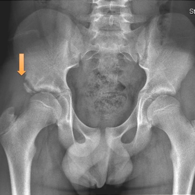 Anterior Inferior Iliac Spine (AIIS) Avulsion Fracture Anterior Inferior Iliac Spine (AIIS) Avulsion Fracture