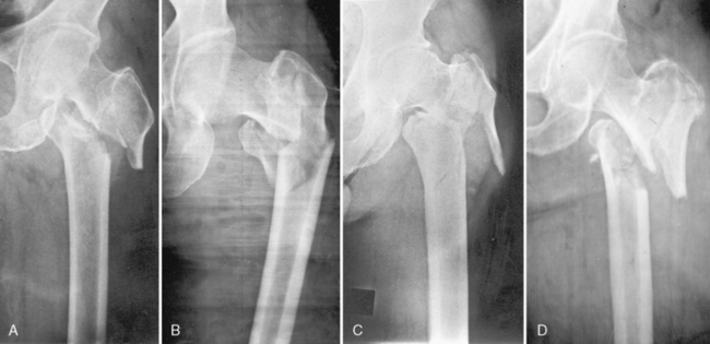 Subtrochanteric Fractures Subtrochanteric Fractures