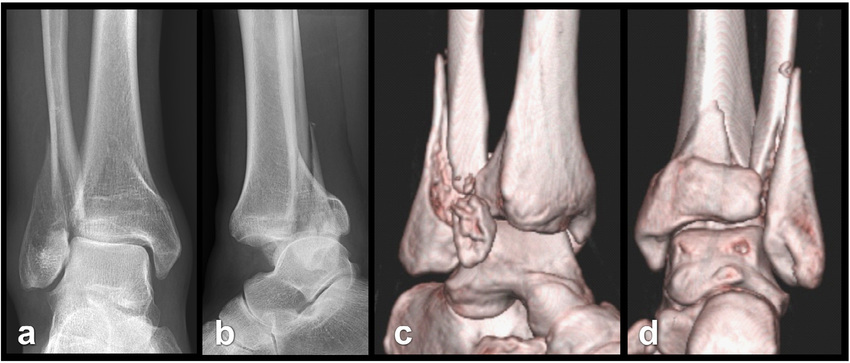 Tillaux Fractures - Causes, Symptoms, Diagnosis, Treatment
