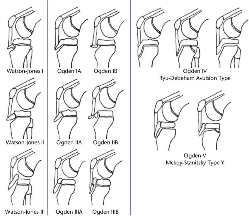 Ogden Classification and Watson-Jones Classification