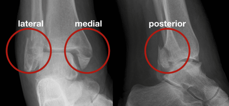 Trimalleolar Fractures - Causes, Symptoms, Diagnosis, Treatment Trimalleolar Fractures - Causes, Symptoms, Diagnosis, Treatment