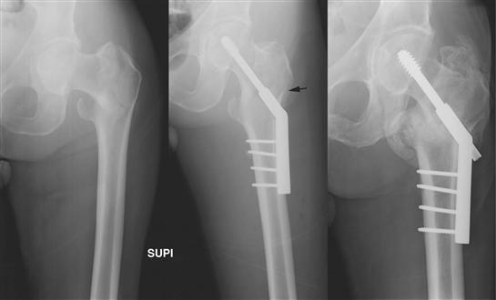 Intertrochanteric Femur Fracture